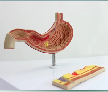 Модель язвы желудка Гастроэнтерология пищеварительная система человека анатомическая форма гастрогелькоза